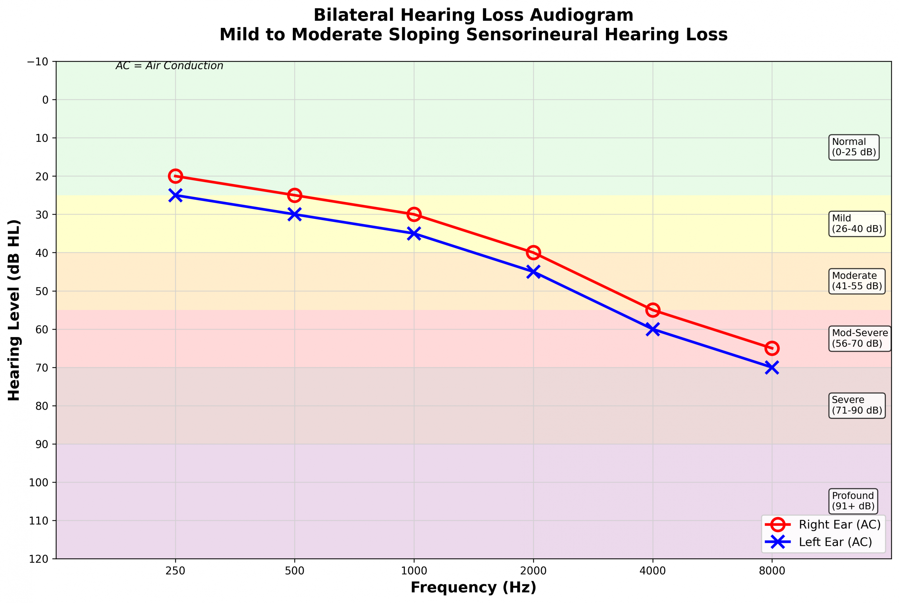 Bilateral hearing loss audiogram