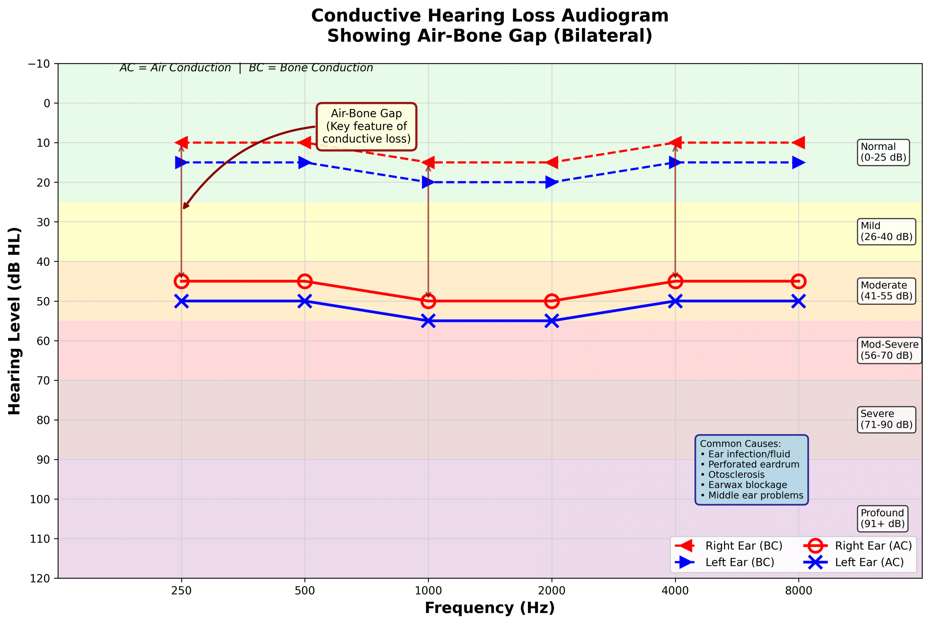 Conductive hearing loss audiogram