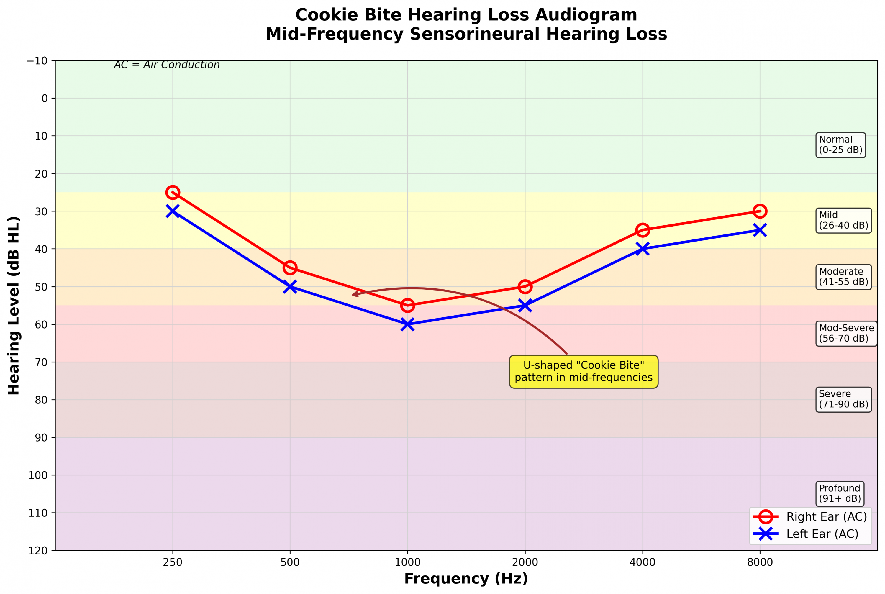 Cookie bite hearing loss audiogram