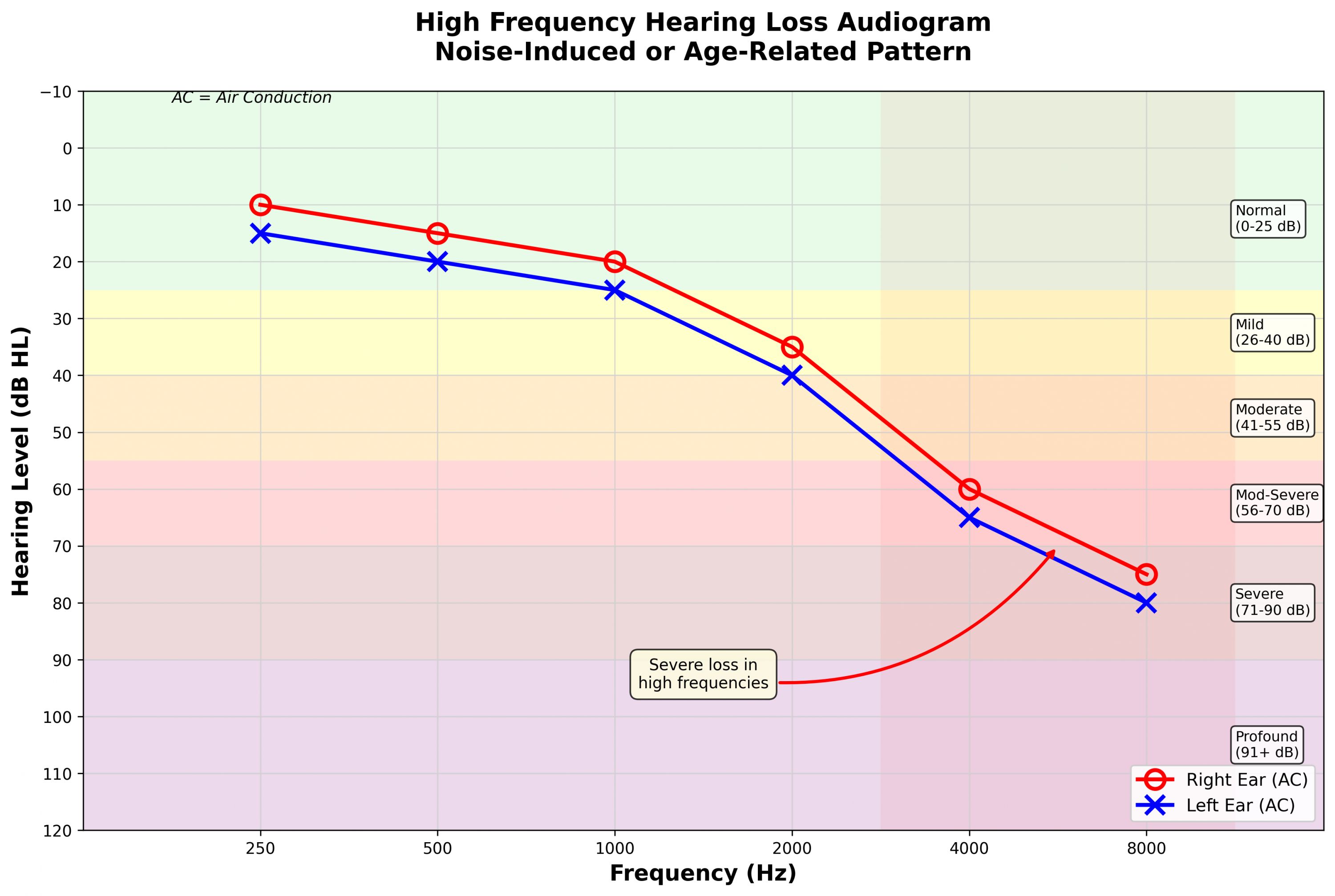 High frequency hearing loss audiogram