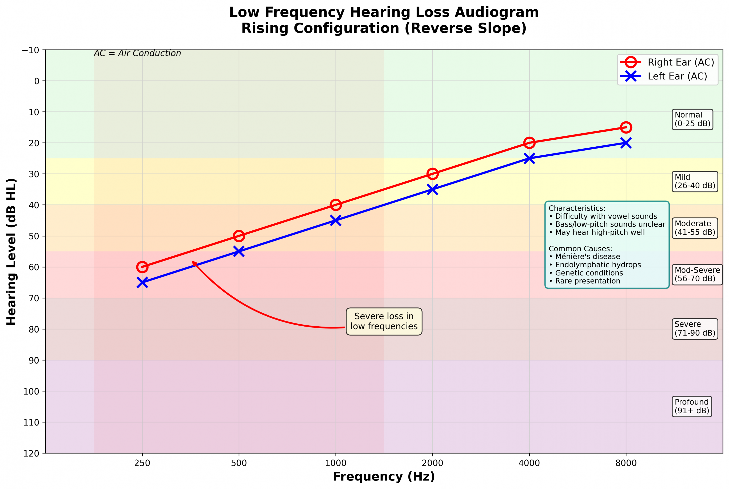 Low frequency hearing loss audiogram
