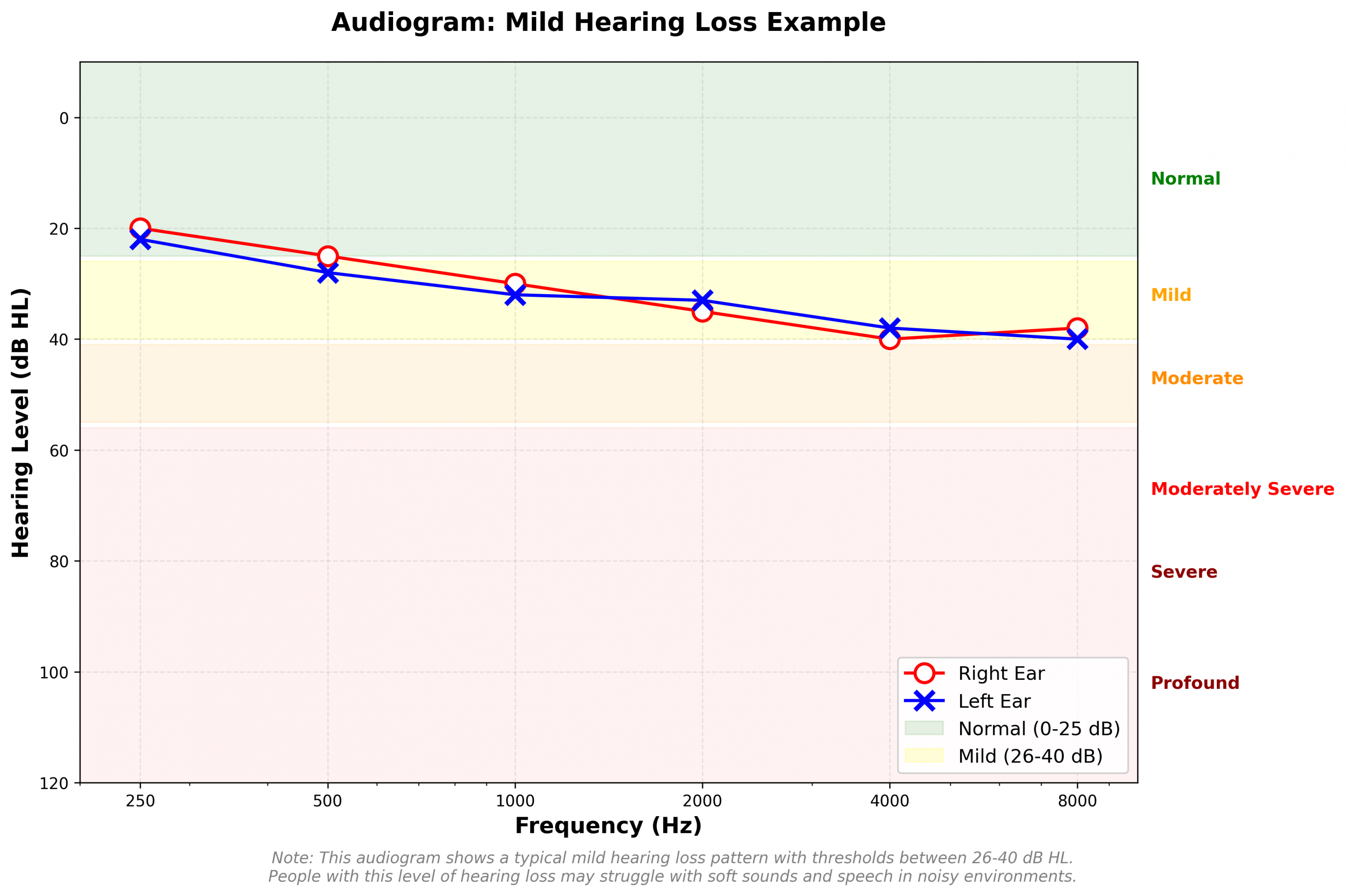 Mild hearing loss audiogram example