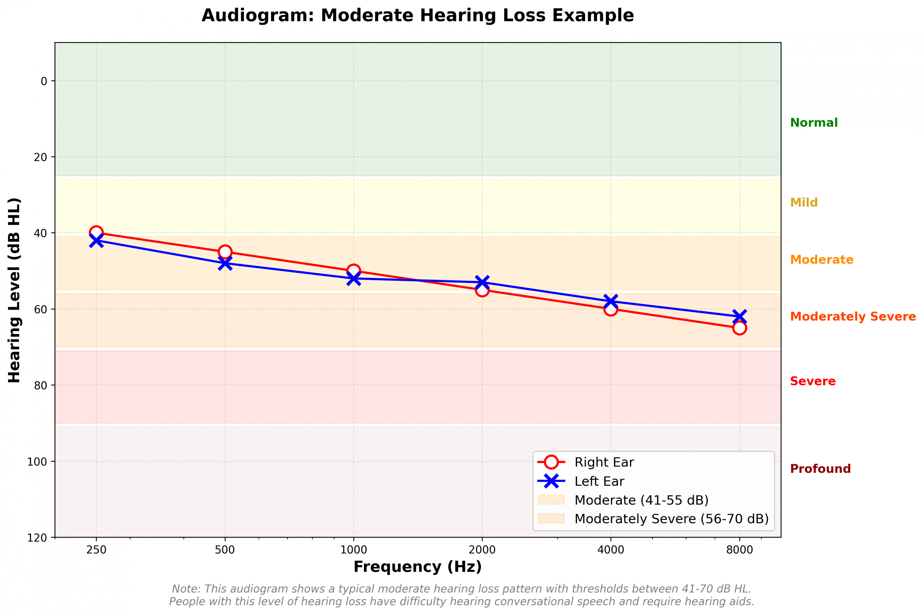 Moderate hearing loss audiogram