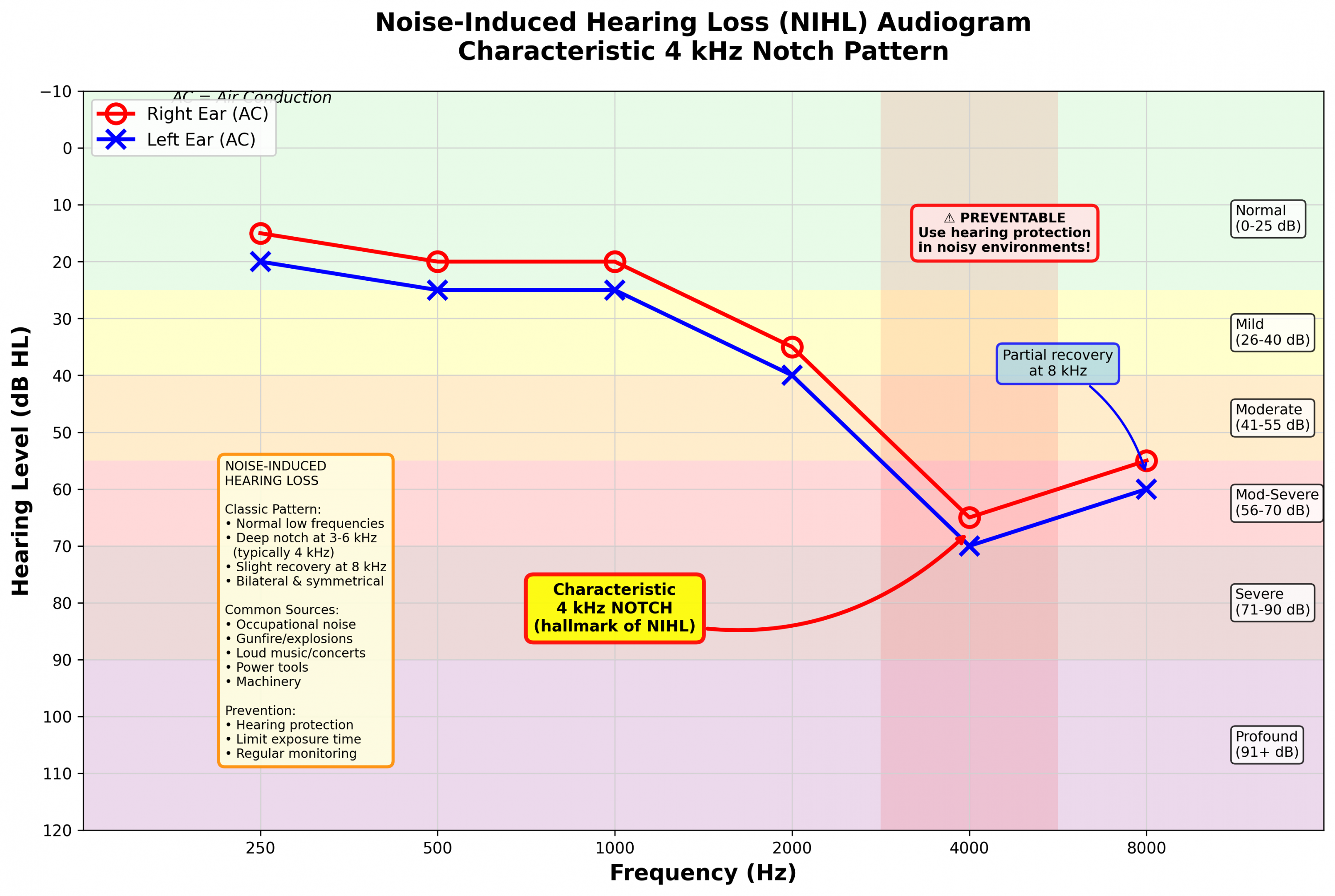 Noise induced hearing loss audiogram