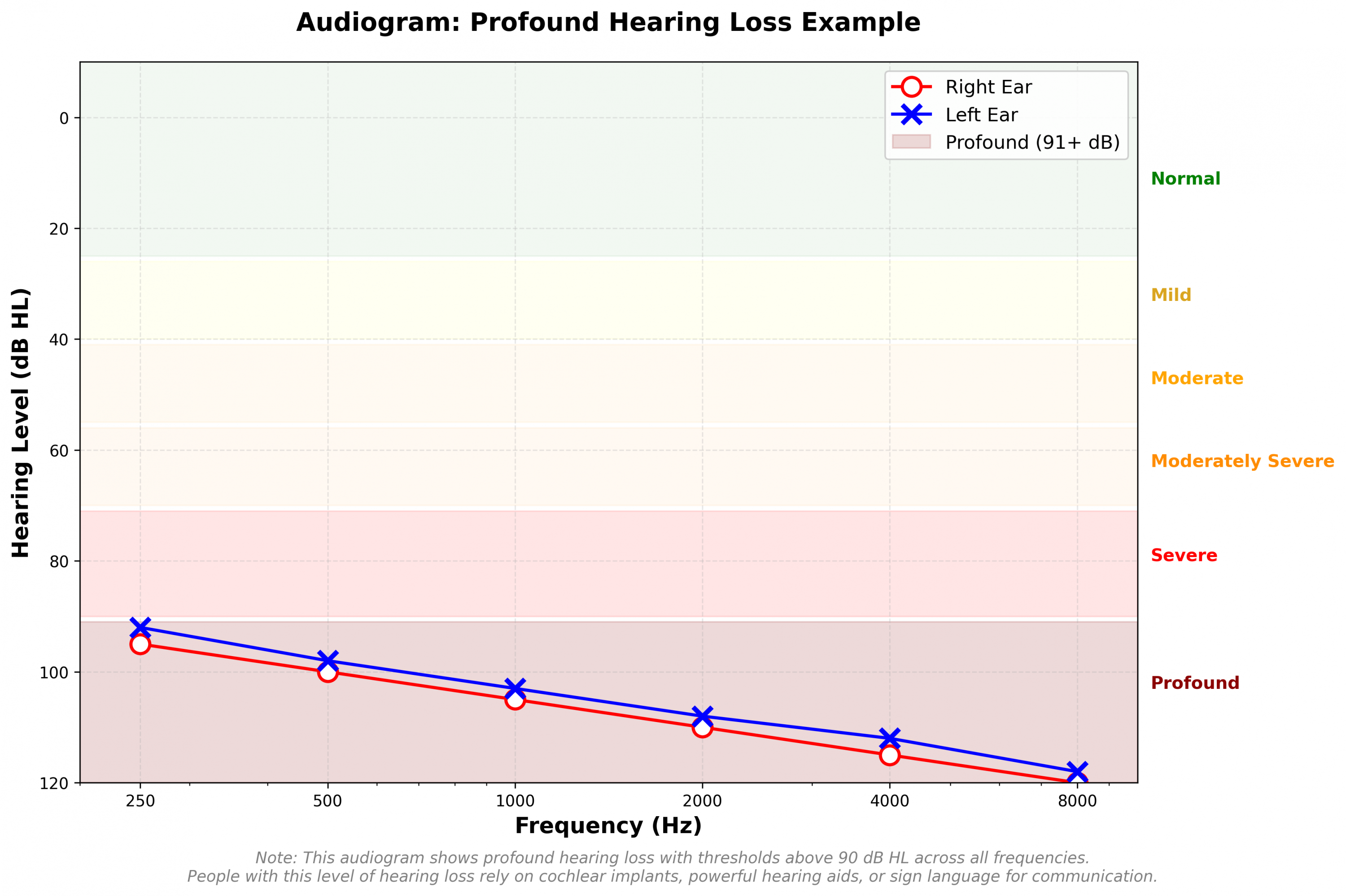 Profound hearing loss audiogram