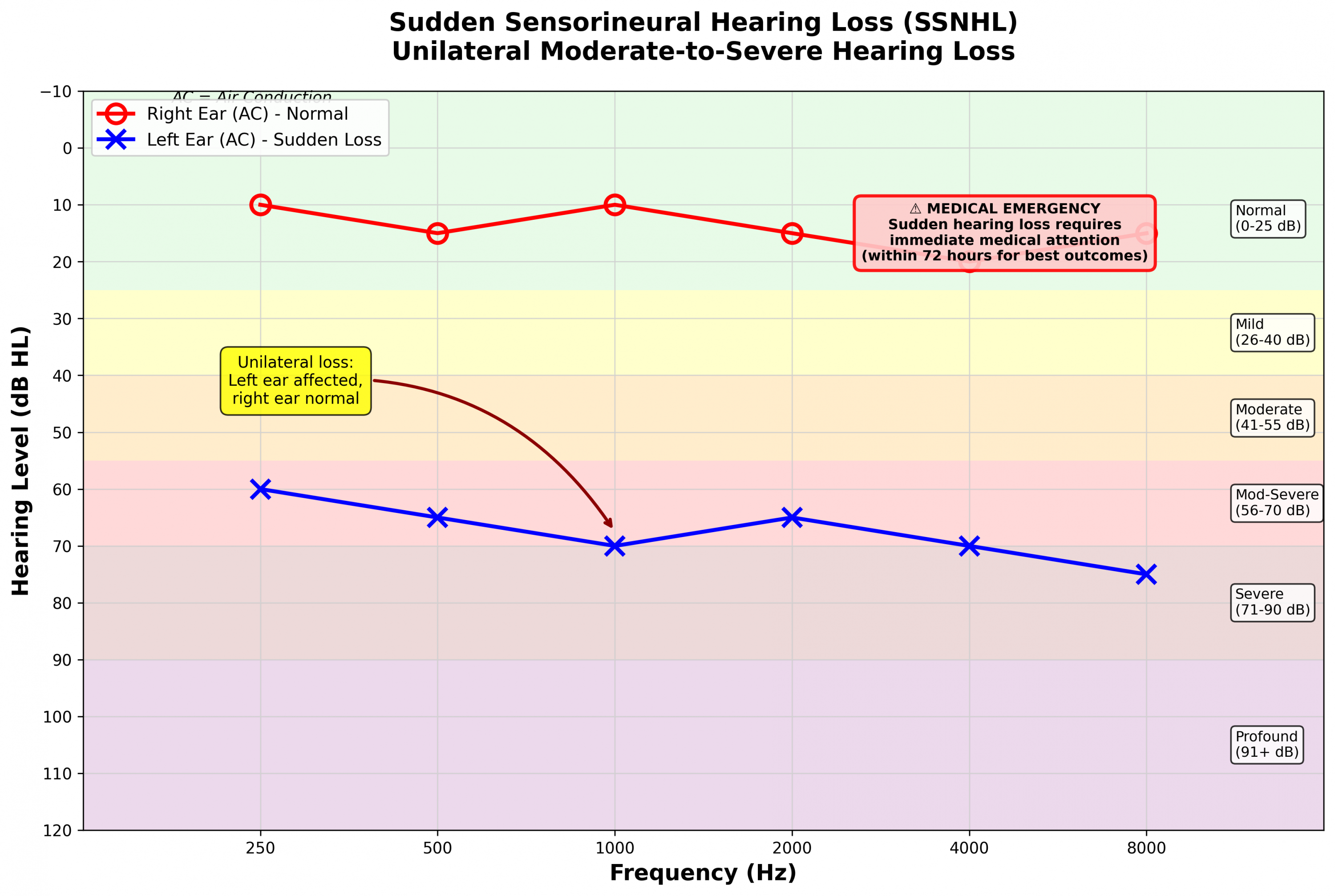 Sudden hearing loss audiogram