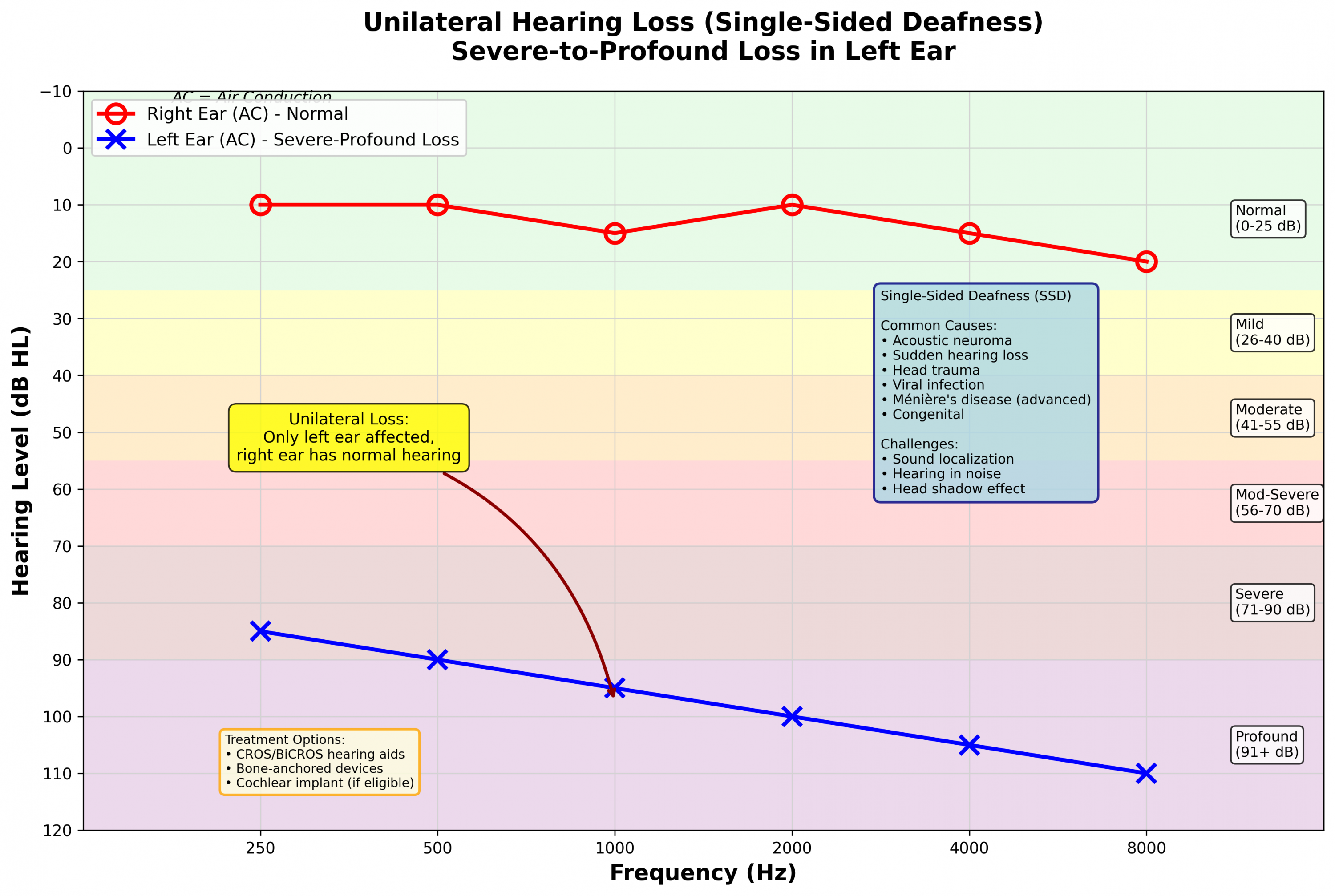 Unilateral hearing loss audiogram